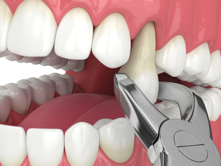 Tooth Extraction Treatment at Isa Smiles in Mount Isa