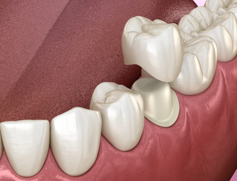 Teeth Crowning Procedure