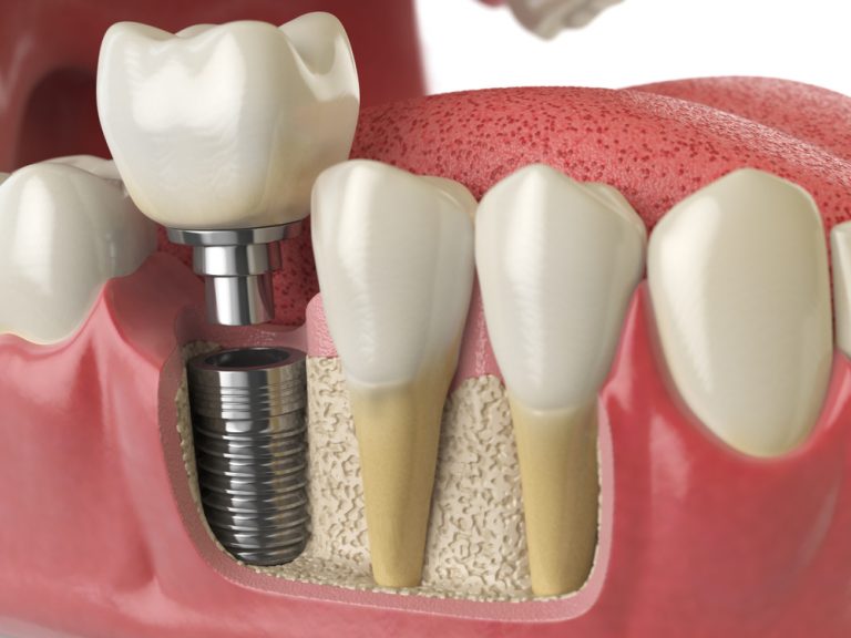 Dental Implants Process Model at Isa Smiles